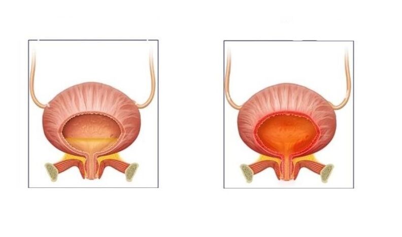 Φυσιολογικό και ασθενείς με κυστίτιδα του ουροποιητικού συστήματος