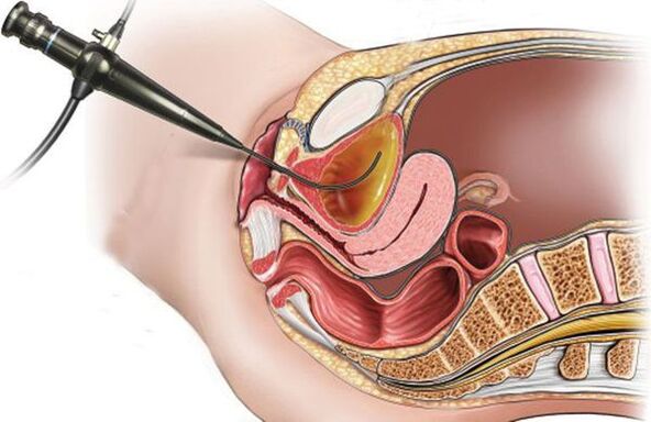 κυστεοσκόπηση για κυστίτιδα